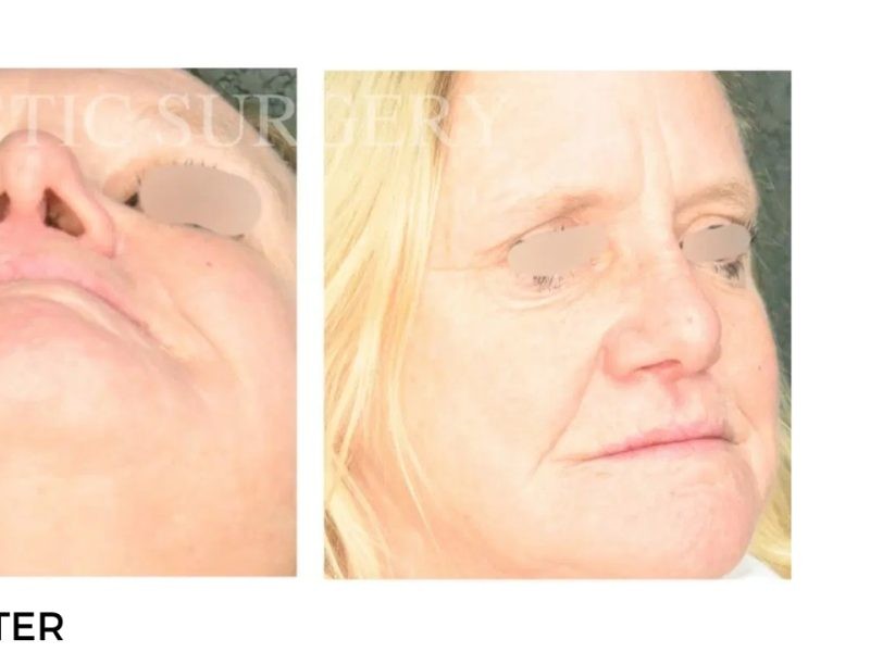 Procedure before and after - after