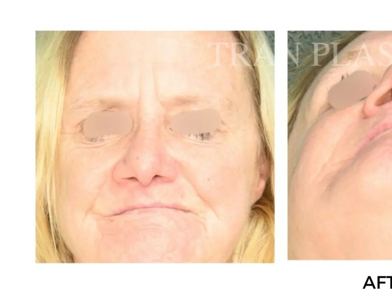 Procedure before and after - before