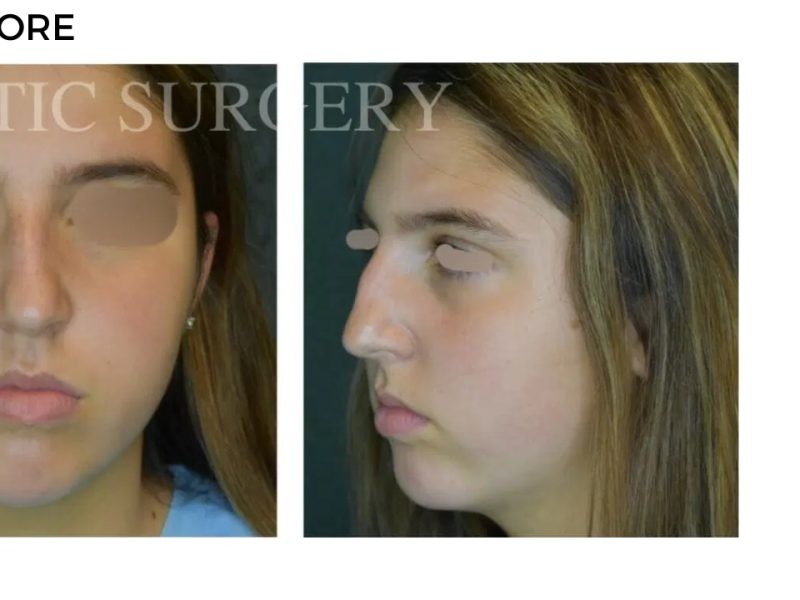 Procedure before and after - after