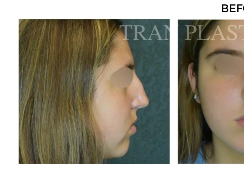 Procedure before and after - before