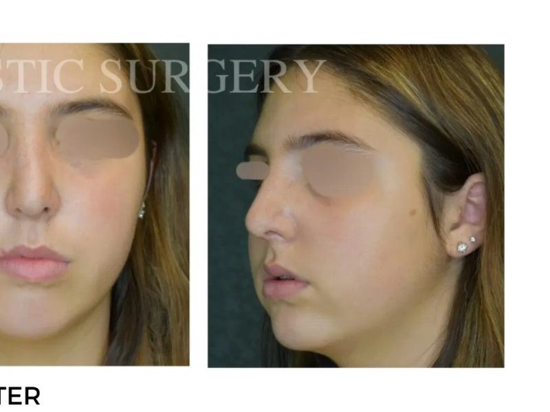 Procedure before and after - after
