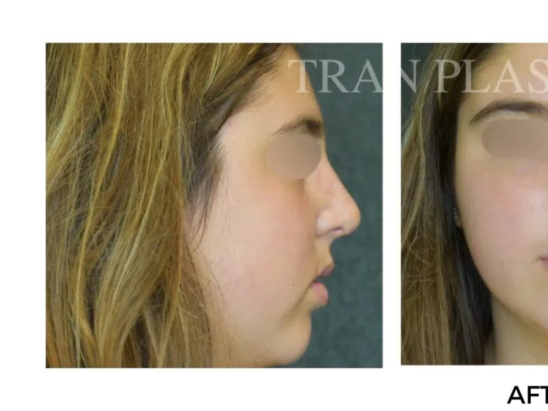 Procedure before and after - before