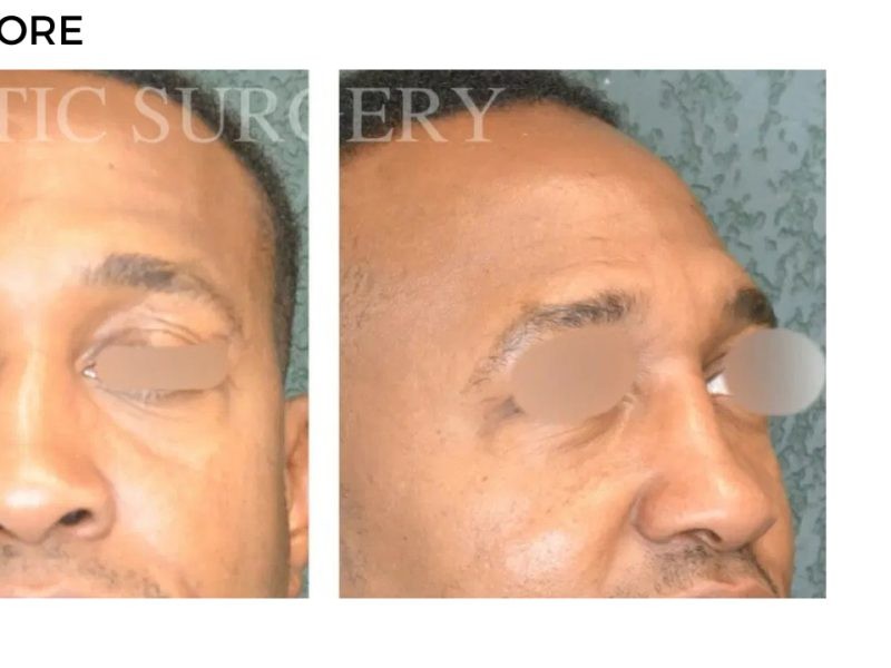 Procedure before and after - after