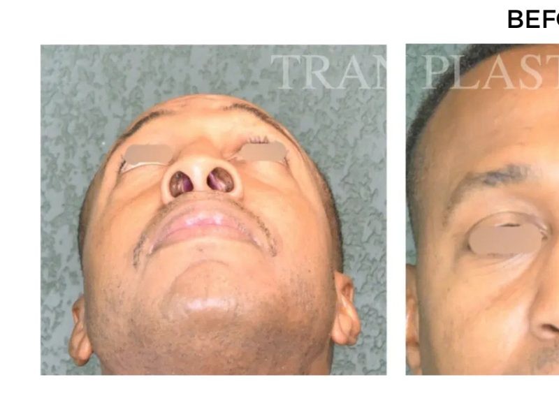 Procedure before and after - before