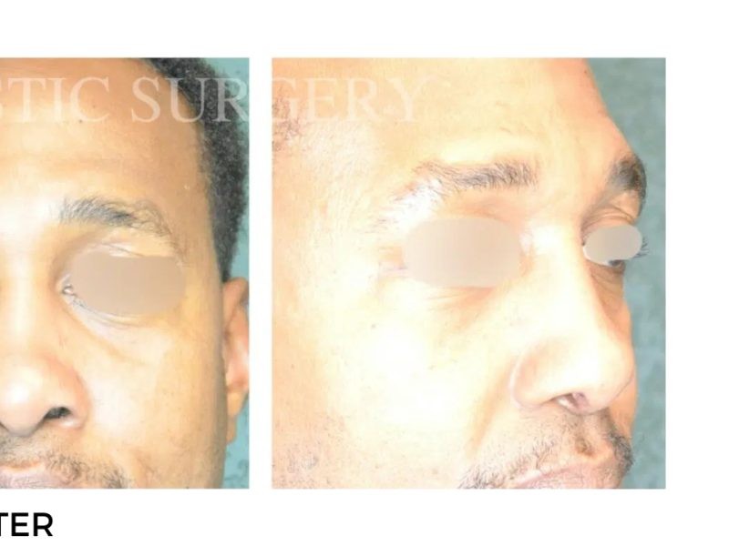 Procedure before and after - after