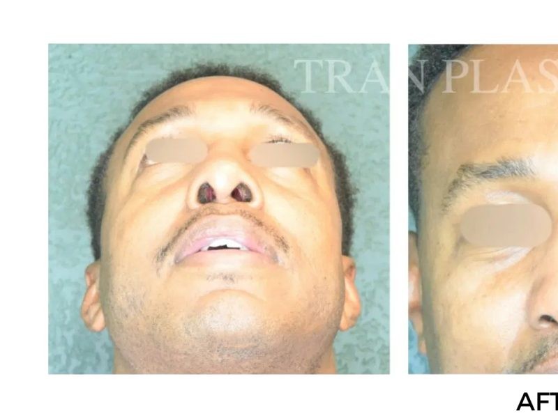 Procedure before and after - before