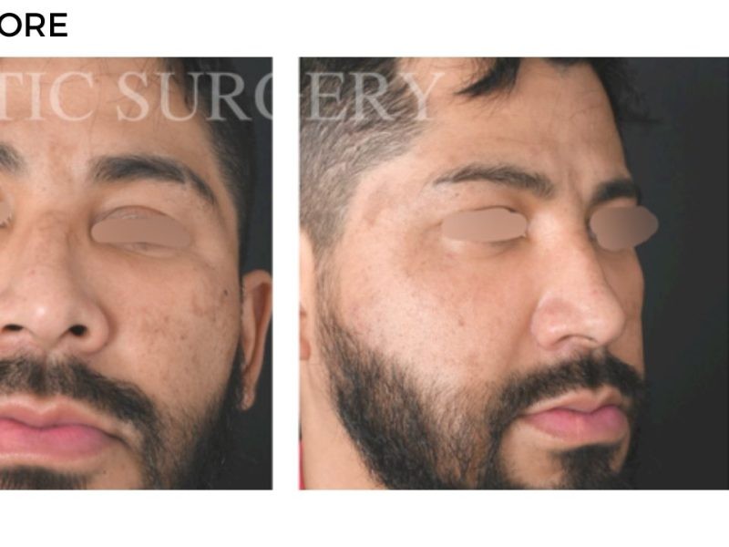 Procedure before and after - after