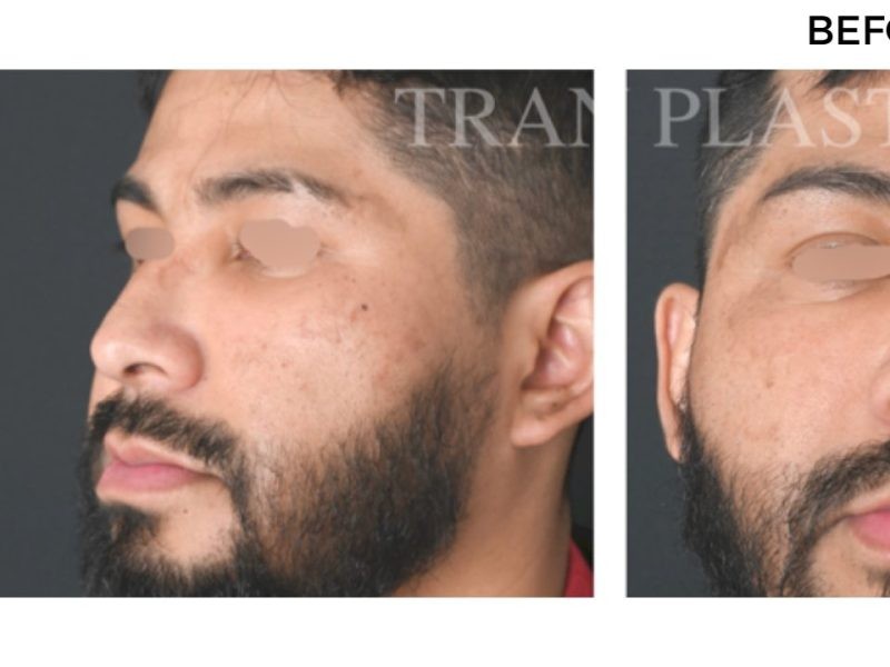 Procedure before and after - before