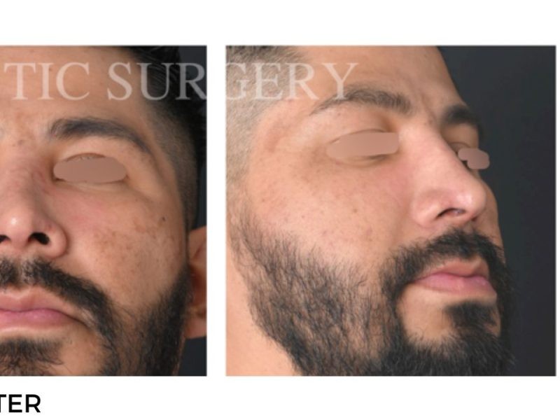 Procedure before and after - after