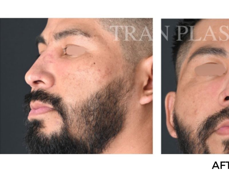 Procedure before and after - before