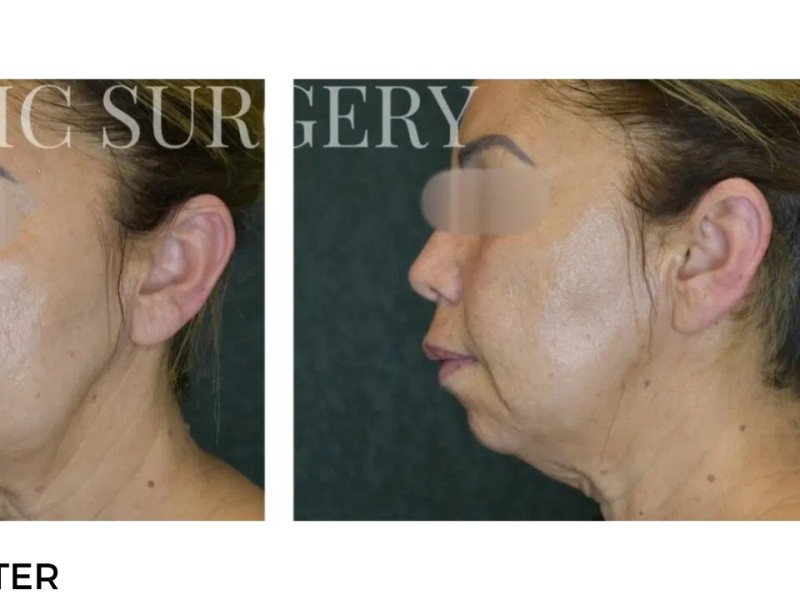 Procedure before and after - after