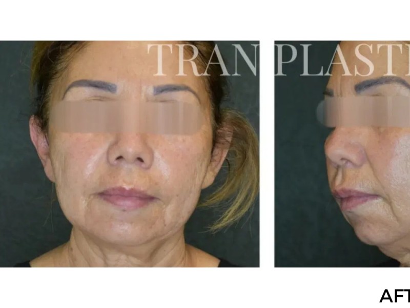 Procedure before and after - before
