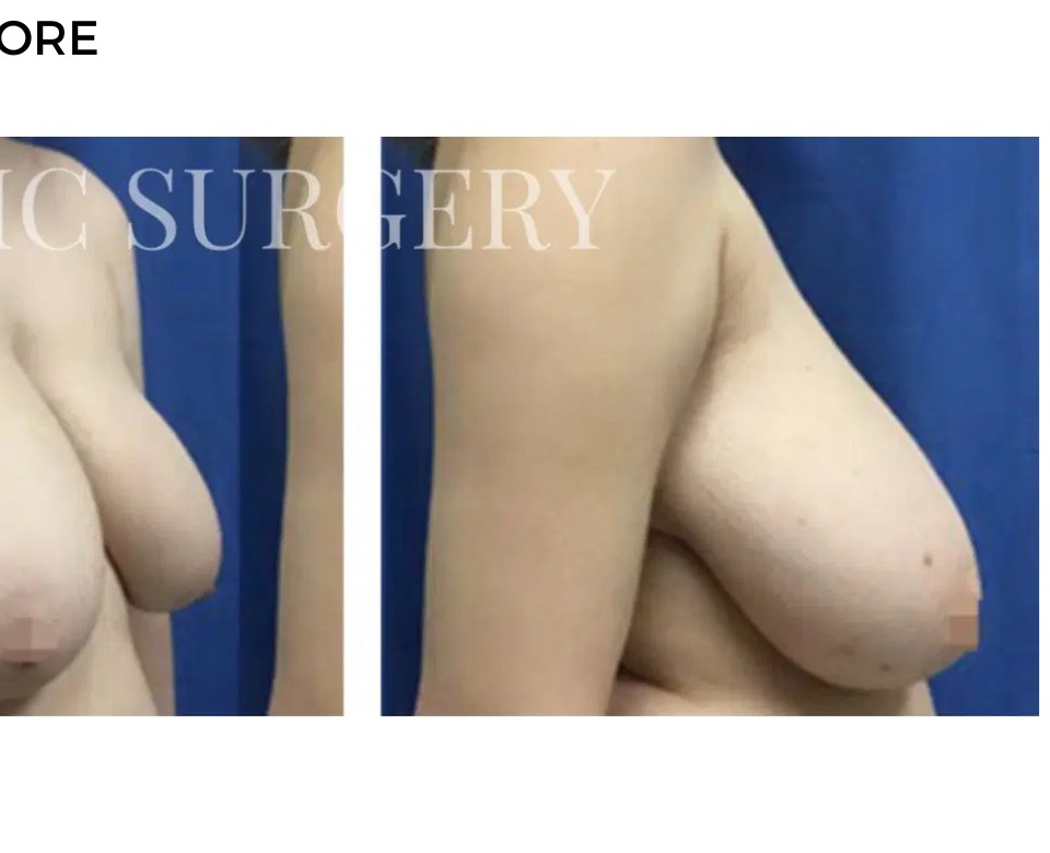 Procedure before and after - after