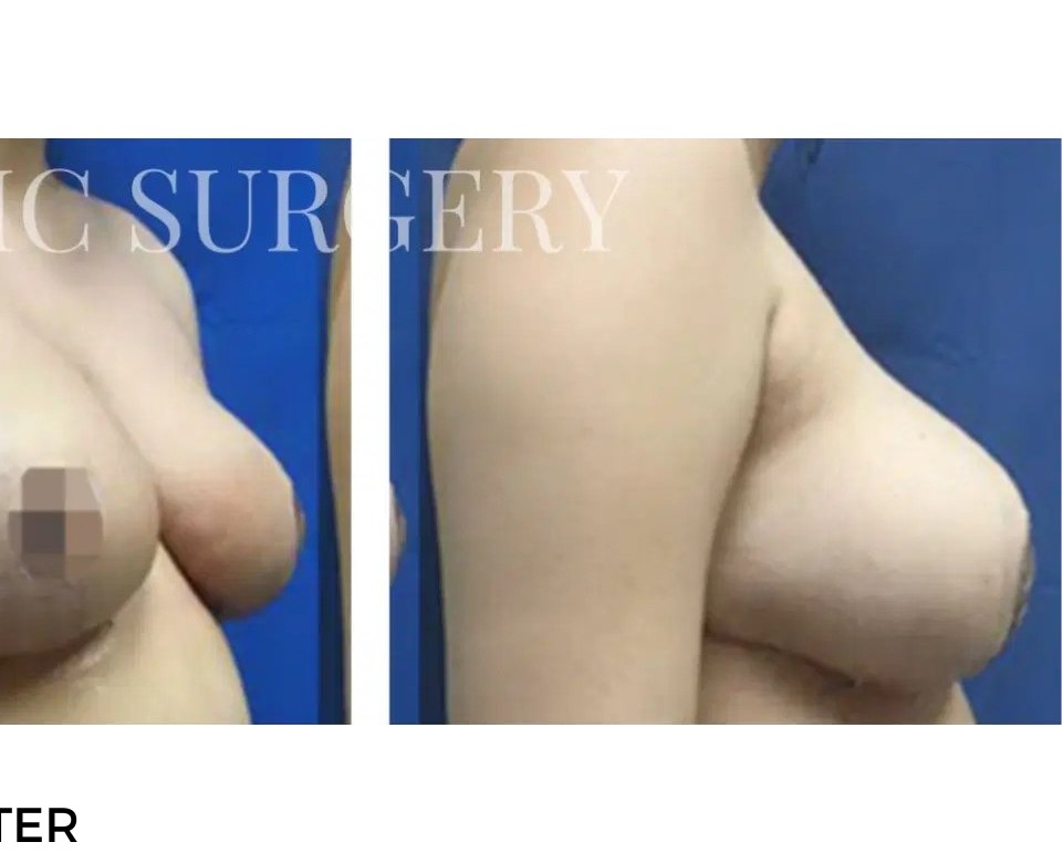Procedure before and after - after