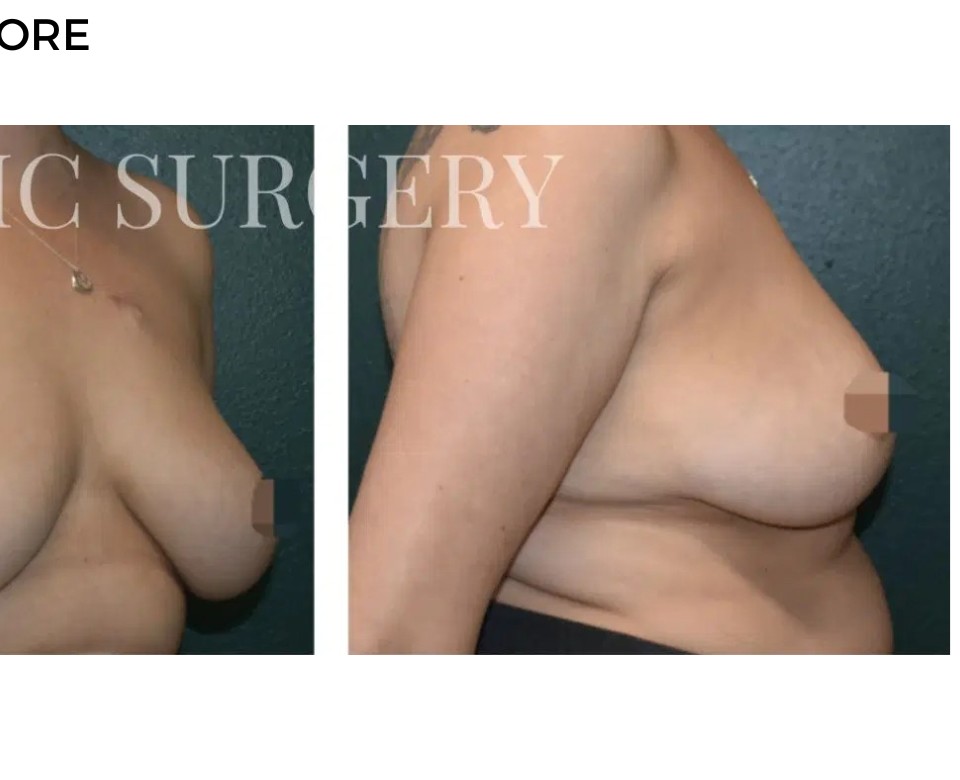 Procedure before and after - after