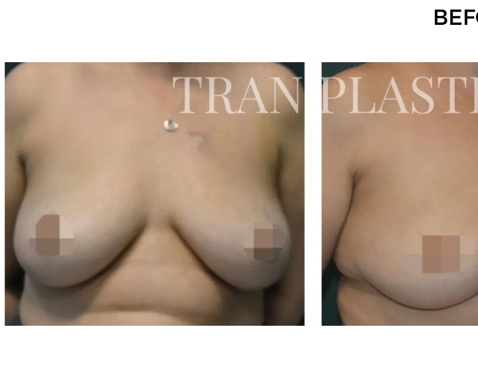 Procedure before and after - before