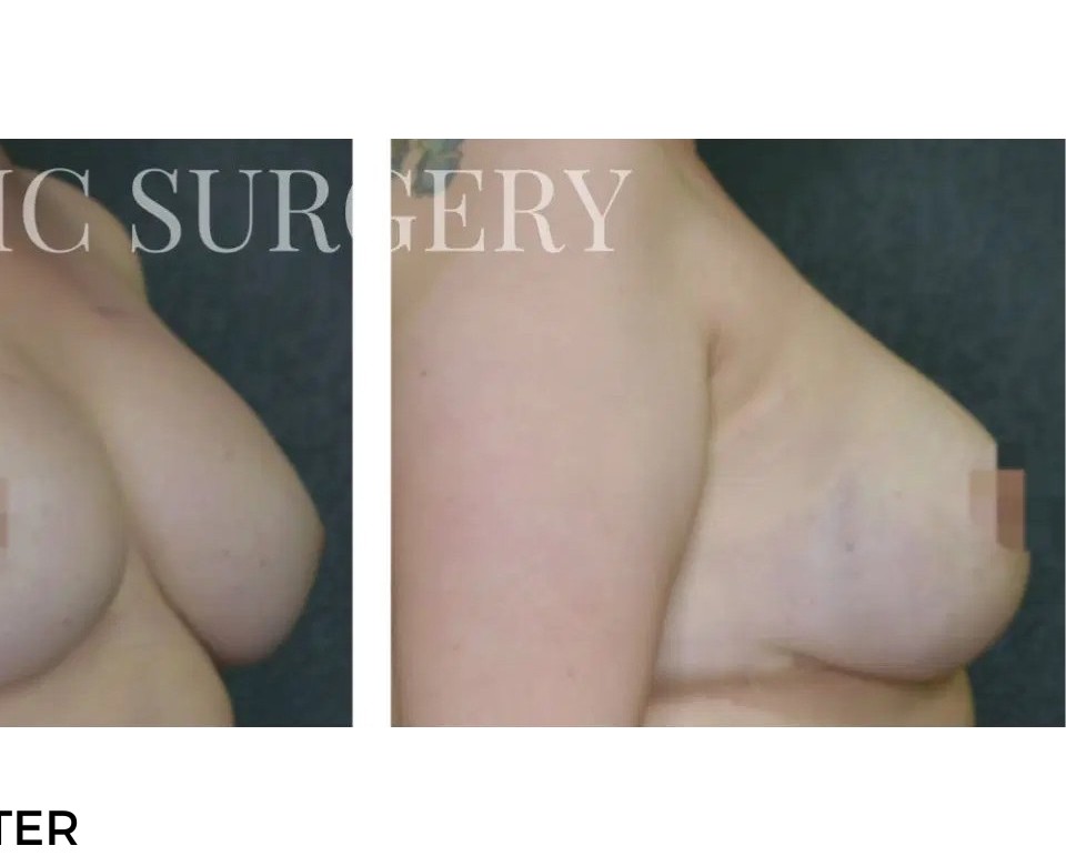 Procedure before and after - after