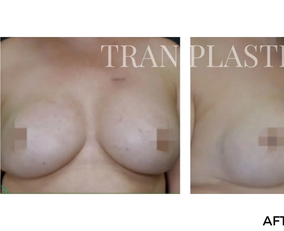 Procedure before and after - before