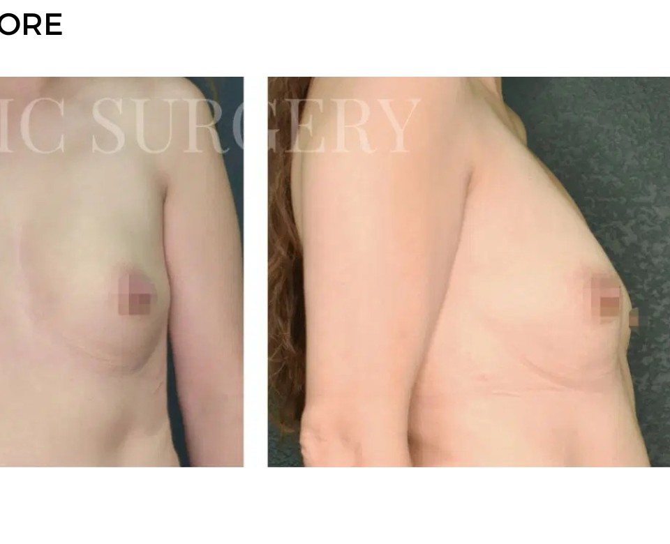 Procedure before and after - after