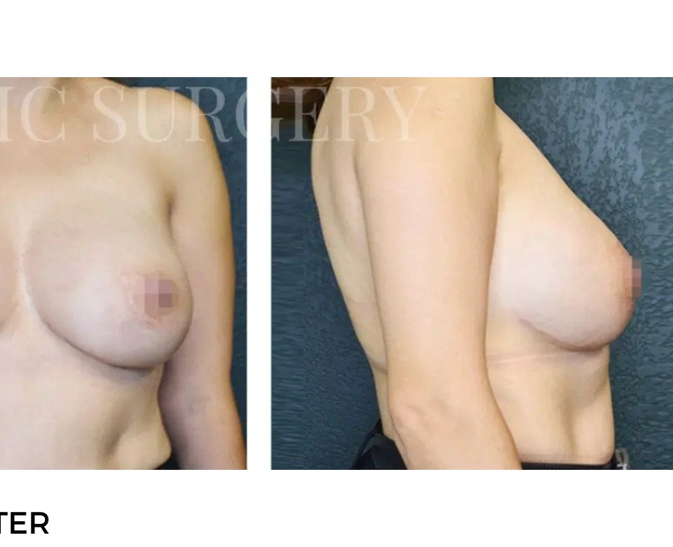 Procedure before and after - after