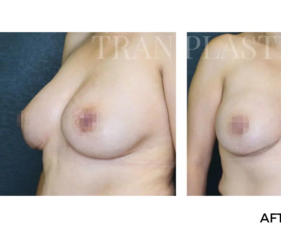 Procedure before and after - before