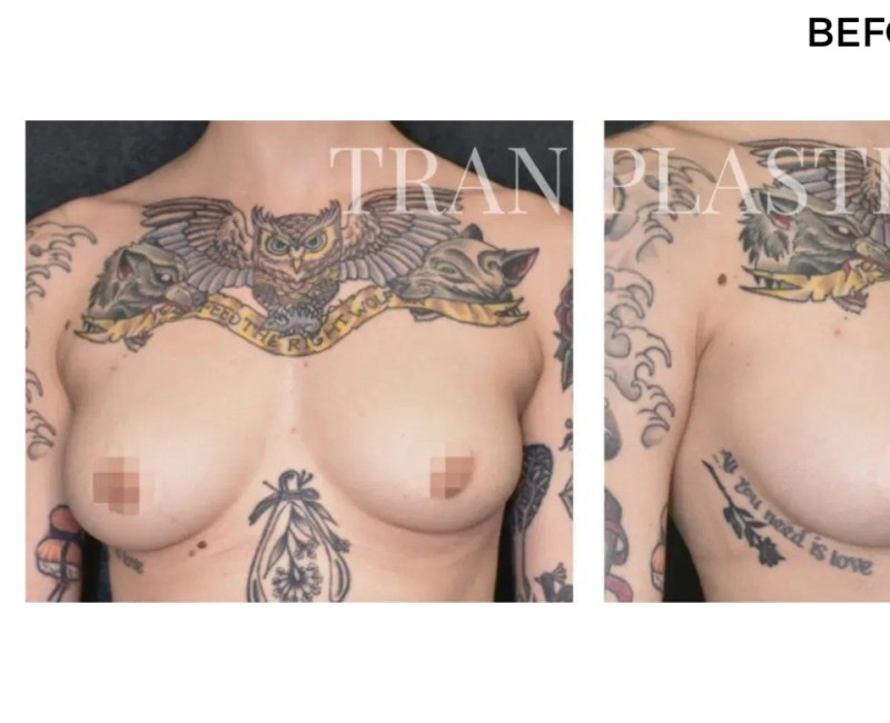 Procedure before and after - before