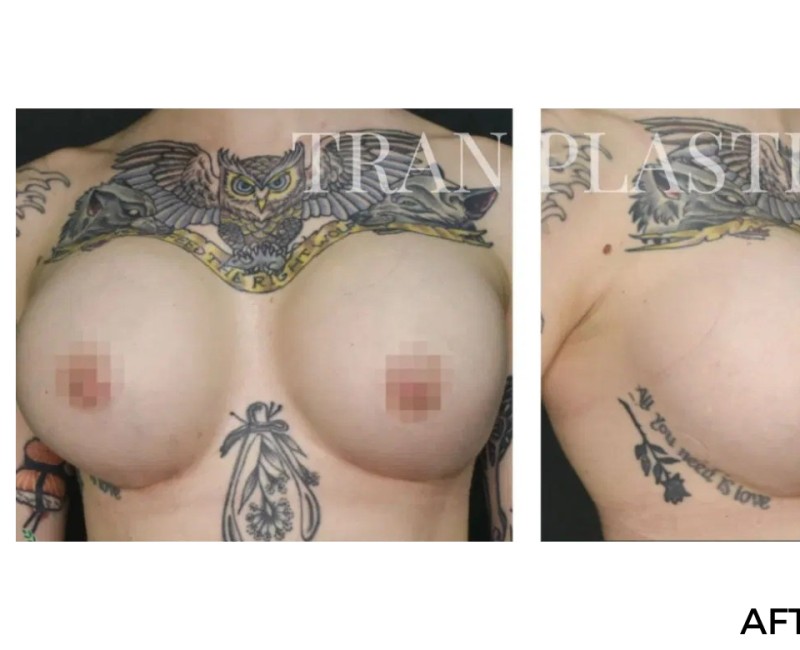 Procedure before and after - before