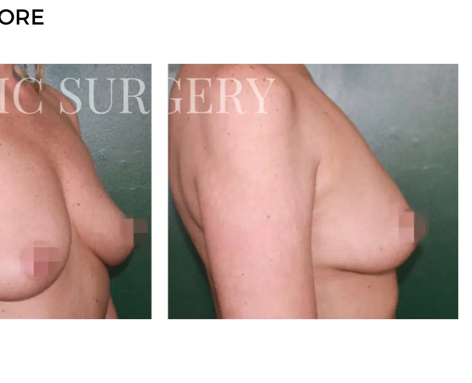 Procedure before and after - after