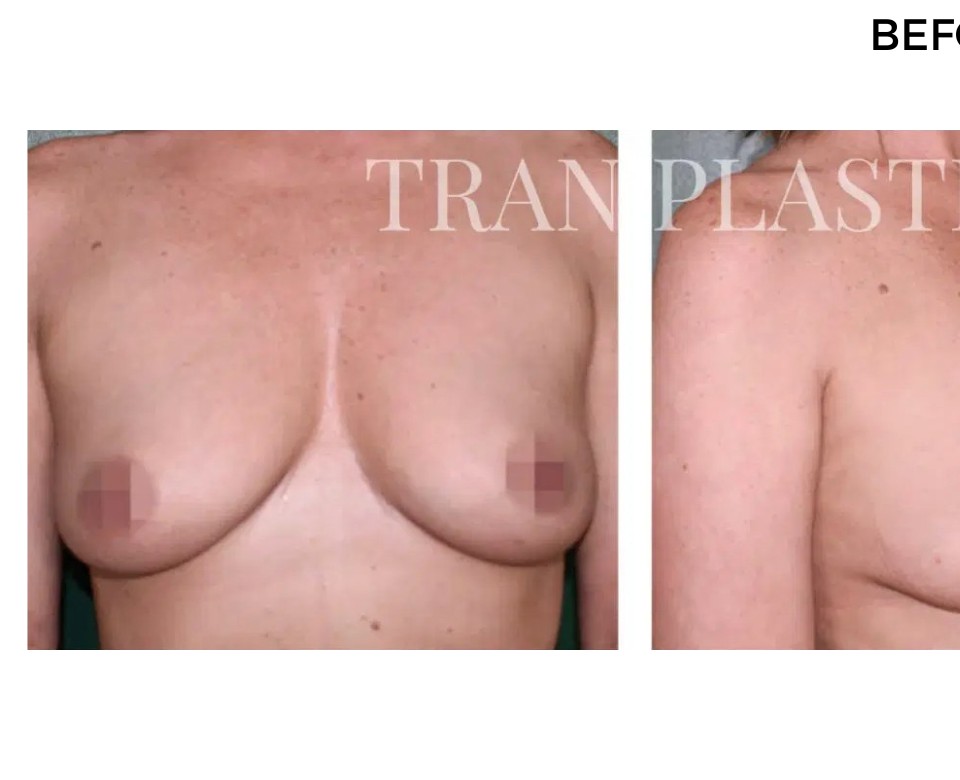 Procedure before and after - before