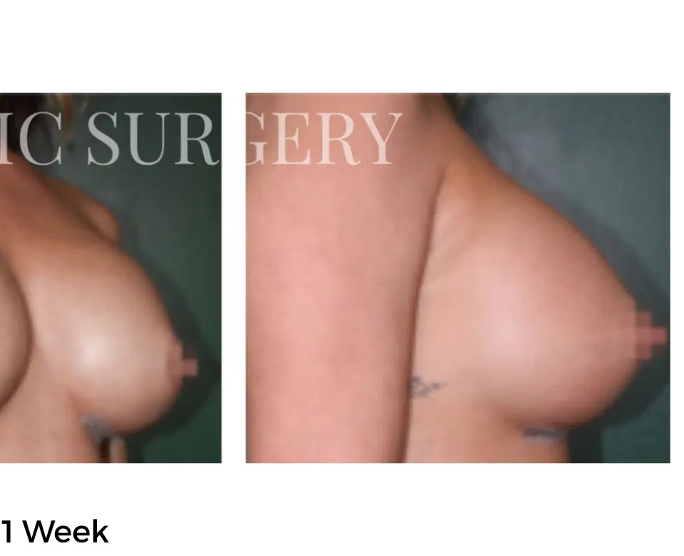 Procedure before and after - after