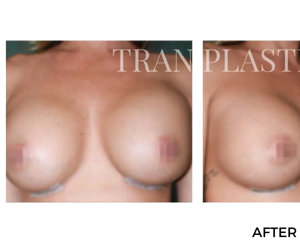 Procedure before and after - before