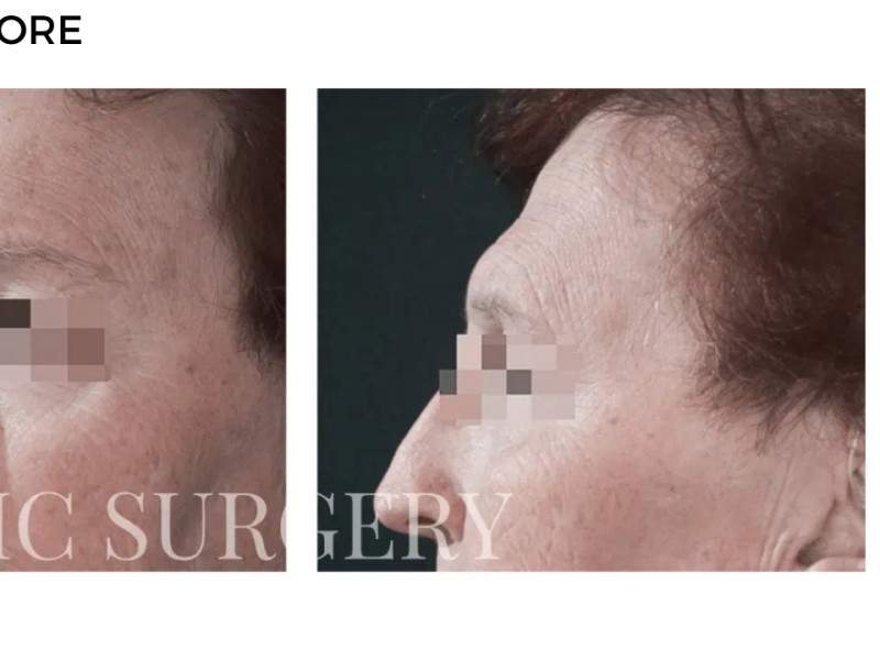 Procedure before and after - after