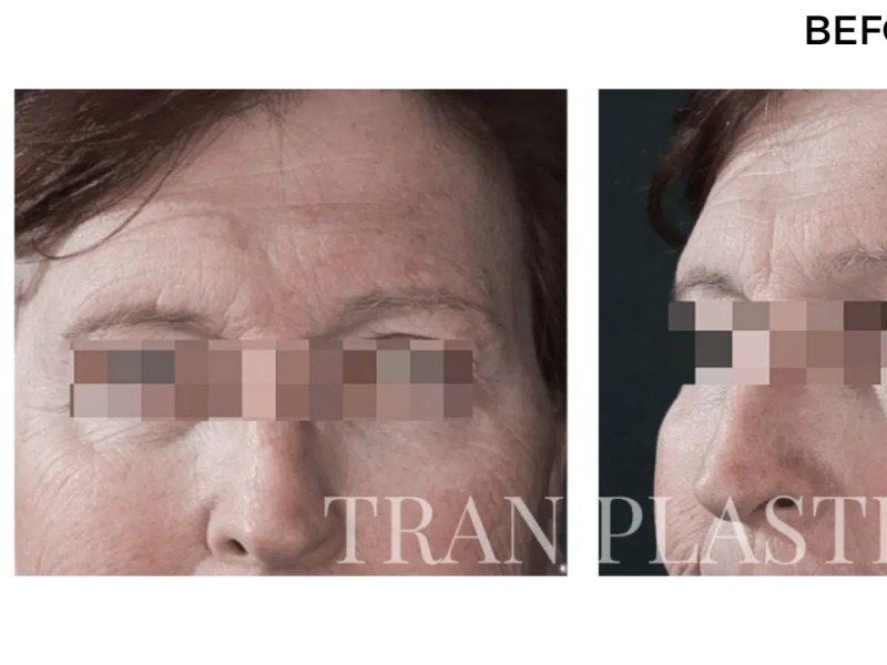 Procedure before and after - before
