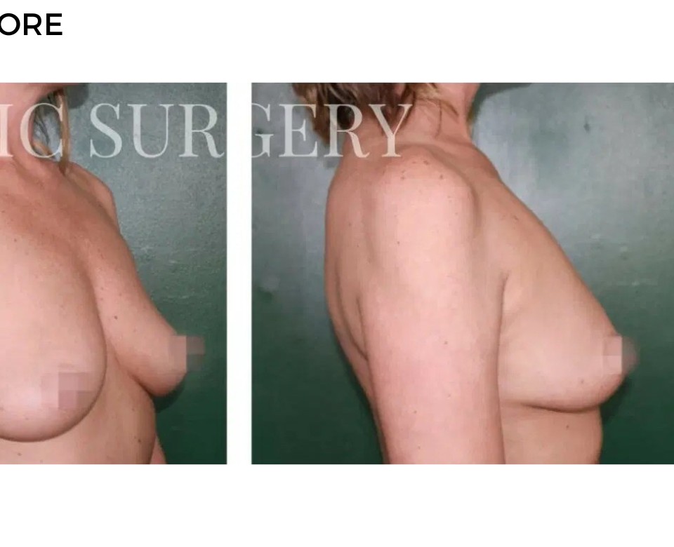 Procedure before and after - after