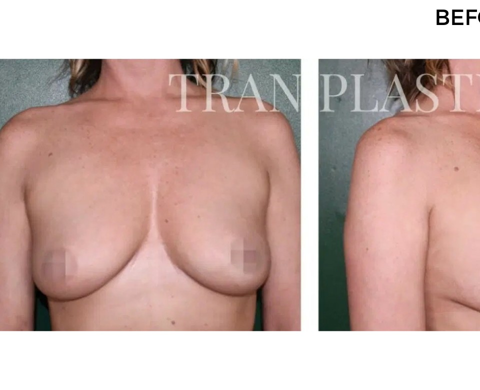 Procedure before and after - before