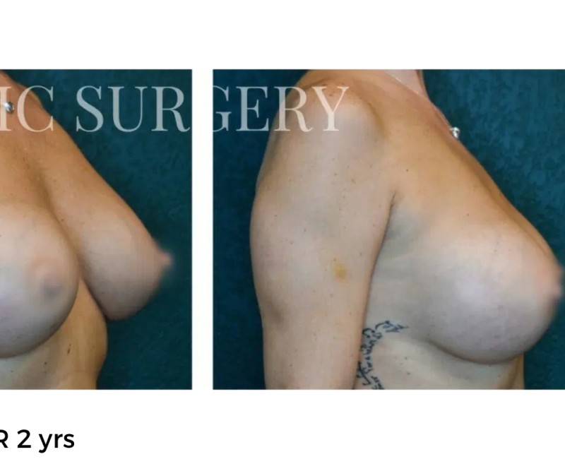 Procedure before and after - after