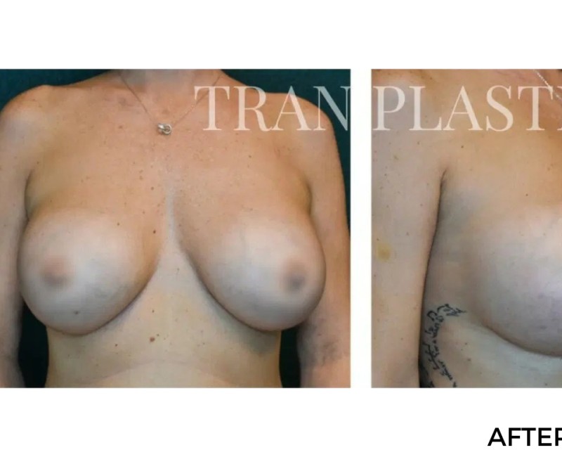 Procedure before and after - before