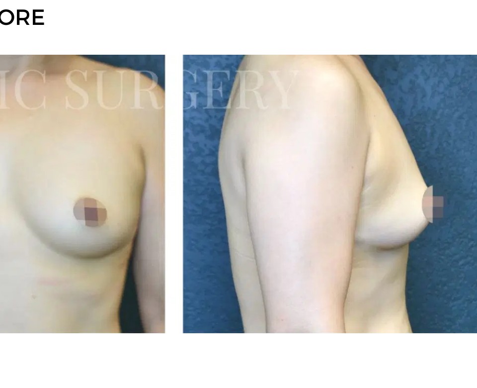Procedure before and after - after