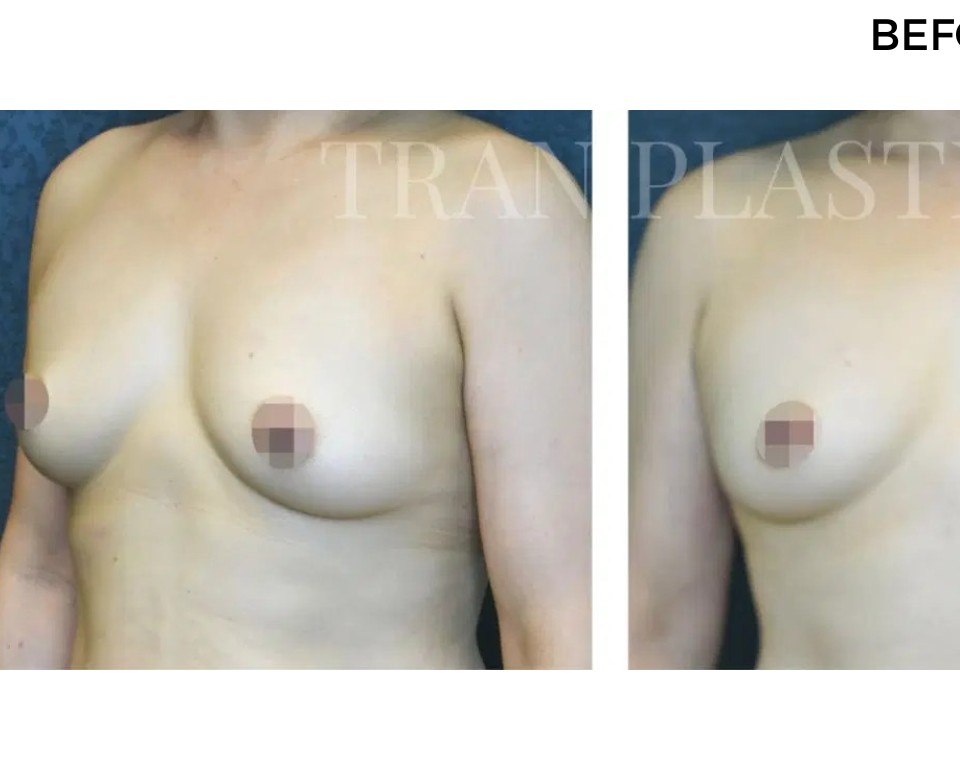 Procedure before and after - before