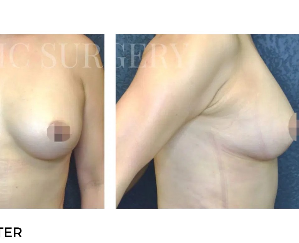 Procedure before and after - after