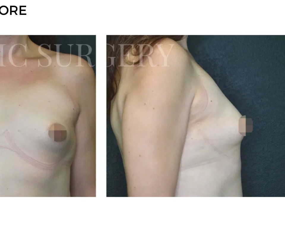 Procedure before and after - after