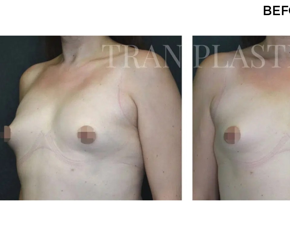 Procedure before and after - before