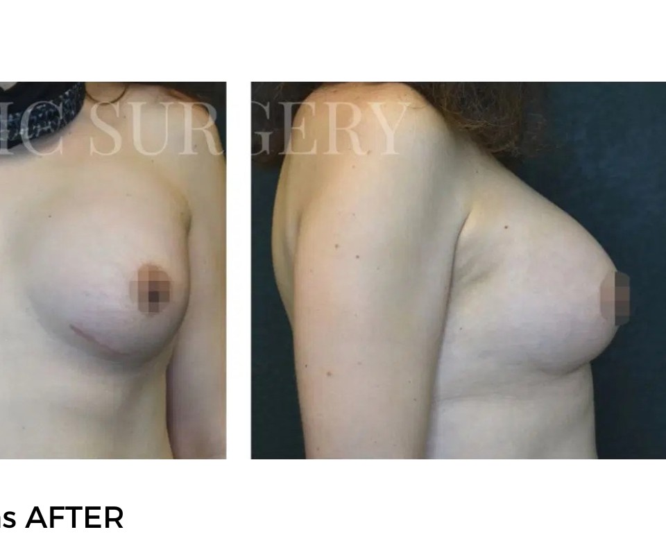 Procedure before and after - after