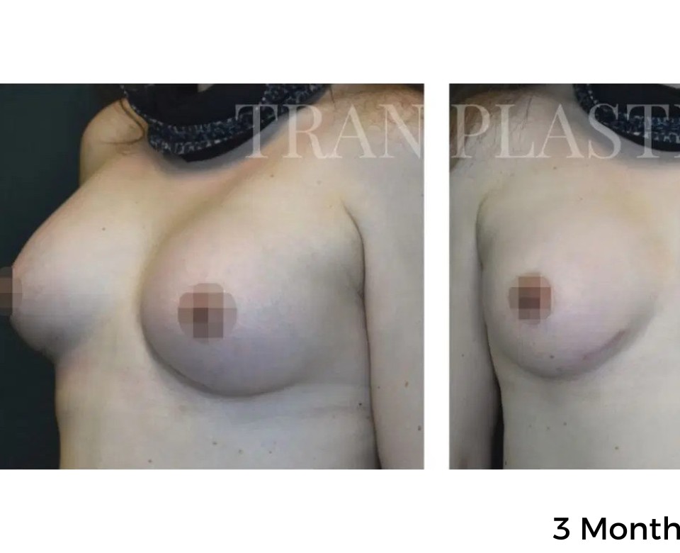Procedure before and after - before