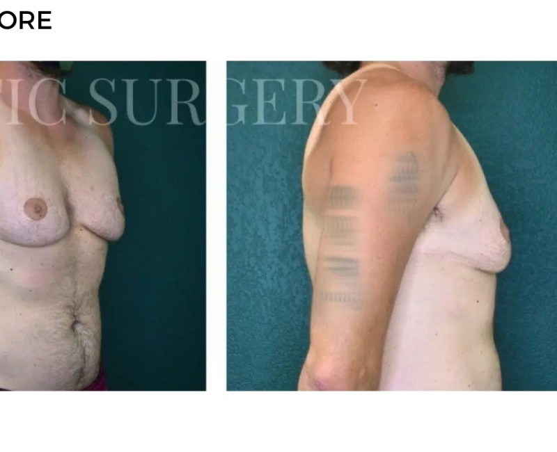 Procedure before and after - after