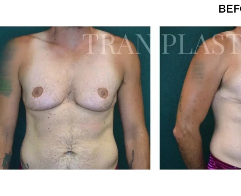 Procedure before and after - before