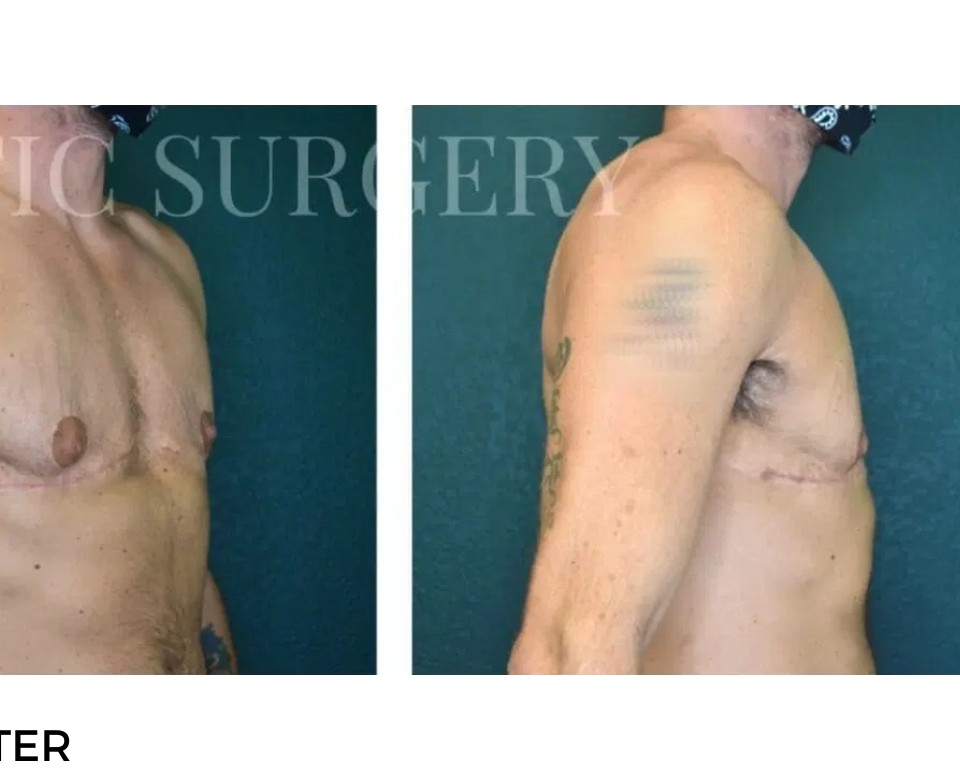 Procedure before and after - after