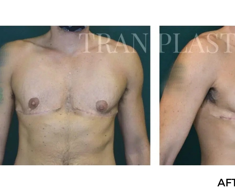 Procedure before and after - before