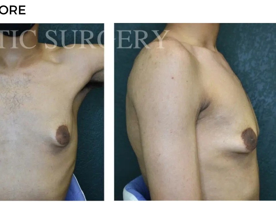 Procedure before and after - after