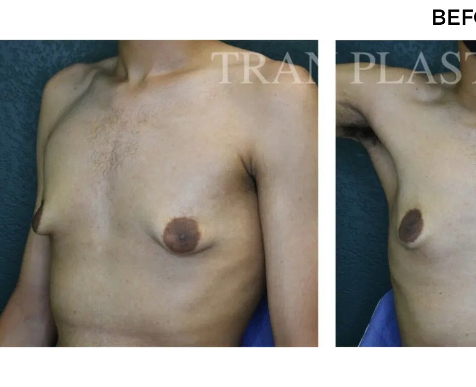 Procedure before and after - before